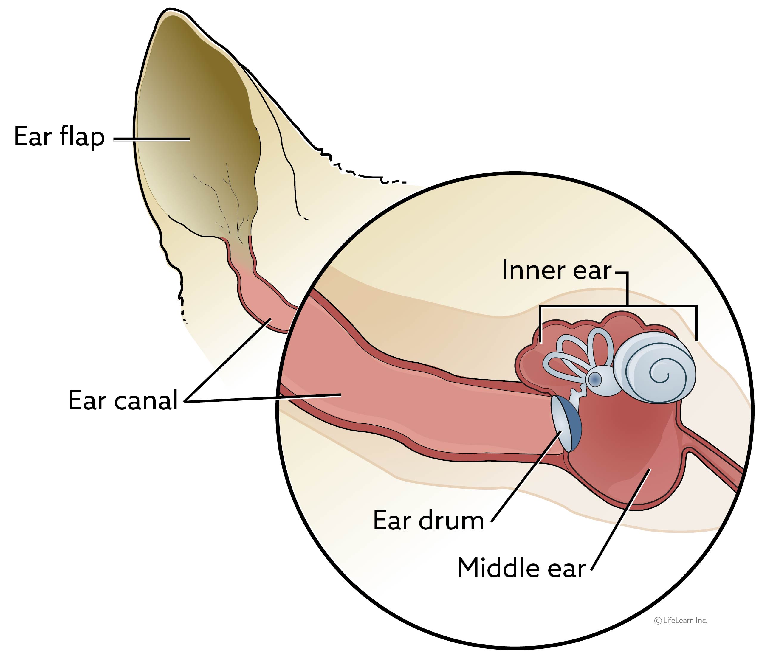 Aural Haemotoma