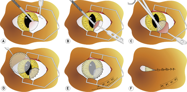 Conjunctival Graft for Rupture Globe