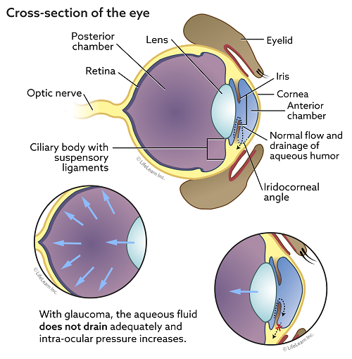 Glaucoma