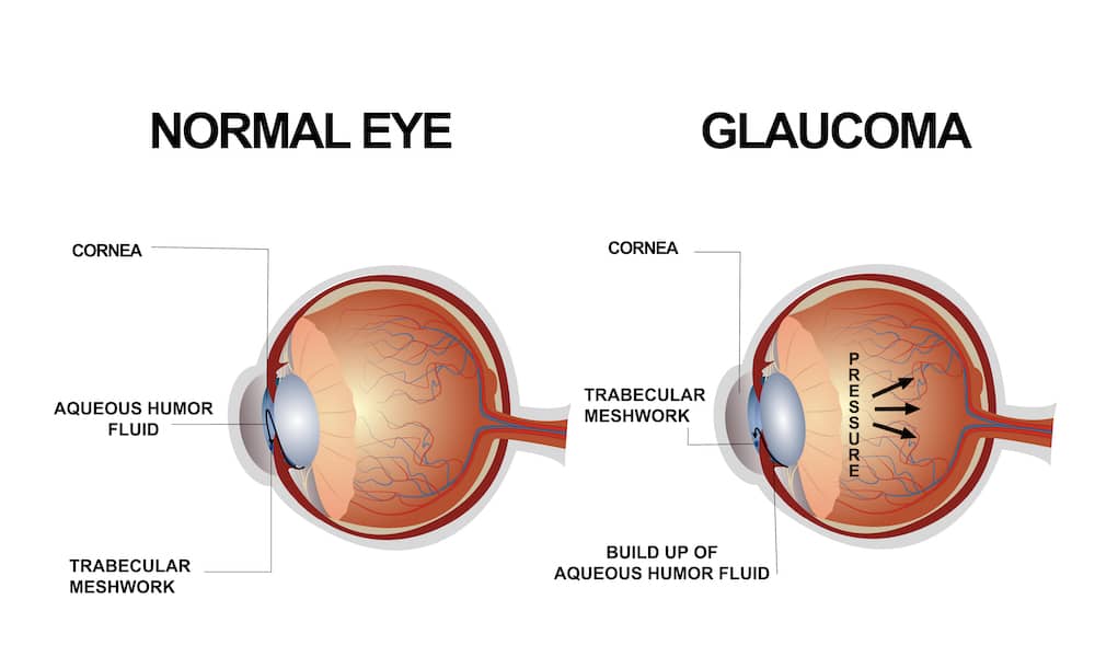 Glaucoma