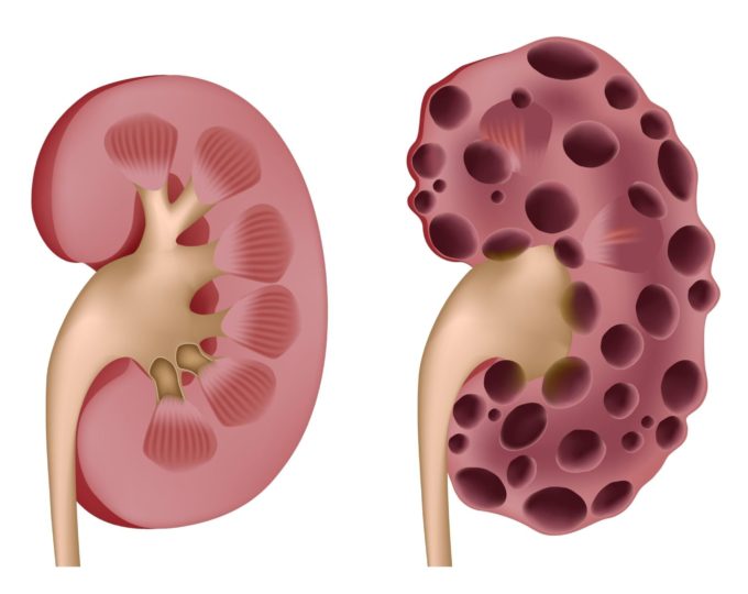 Polycystic Kidney Disease (PKD)