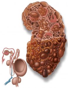 Polycystic Kidney Disease (PKD)