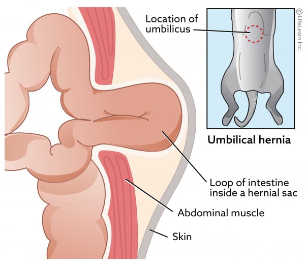 Umbilical Hernia