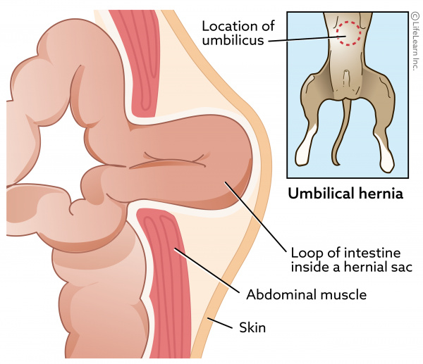 Umbilical Hernia