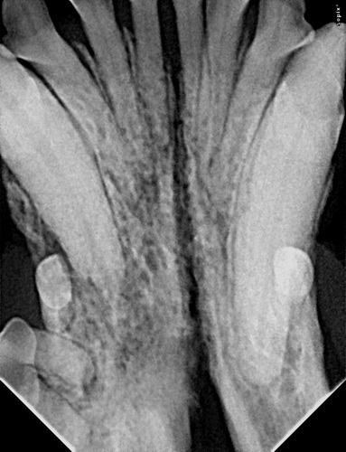 tooth resorption